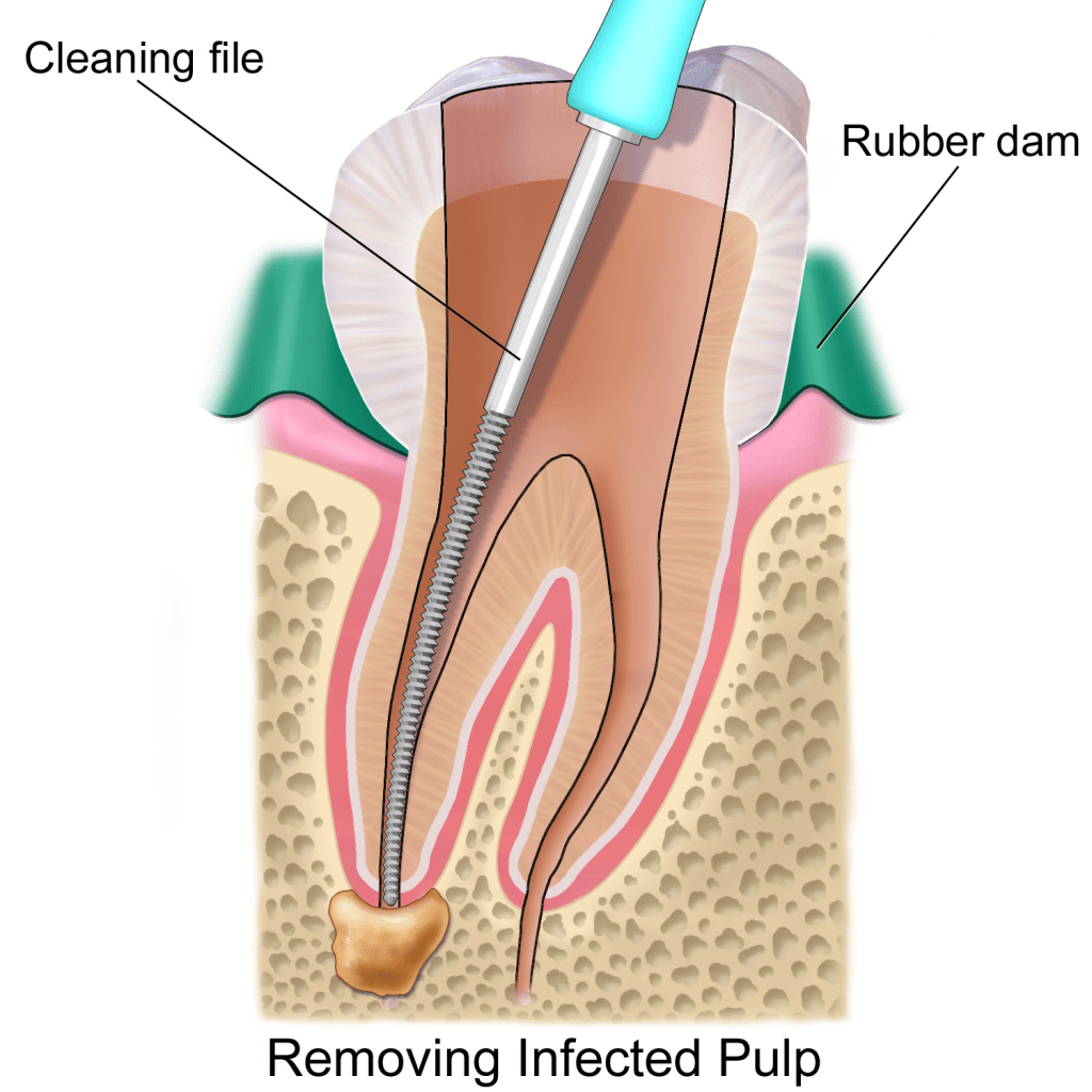 dentist near me. Root Canal