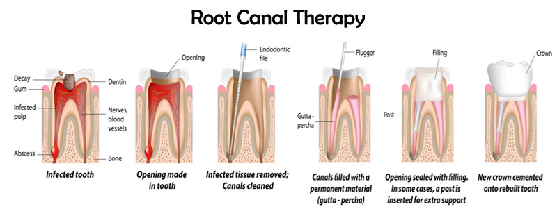 Root canal Therapy