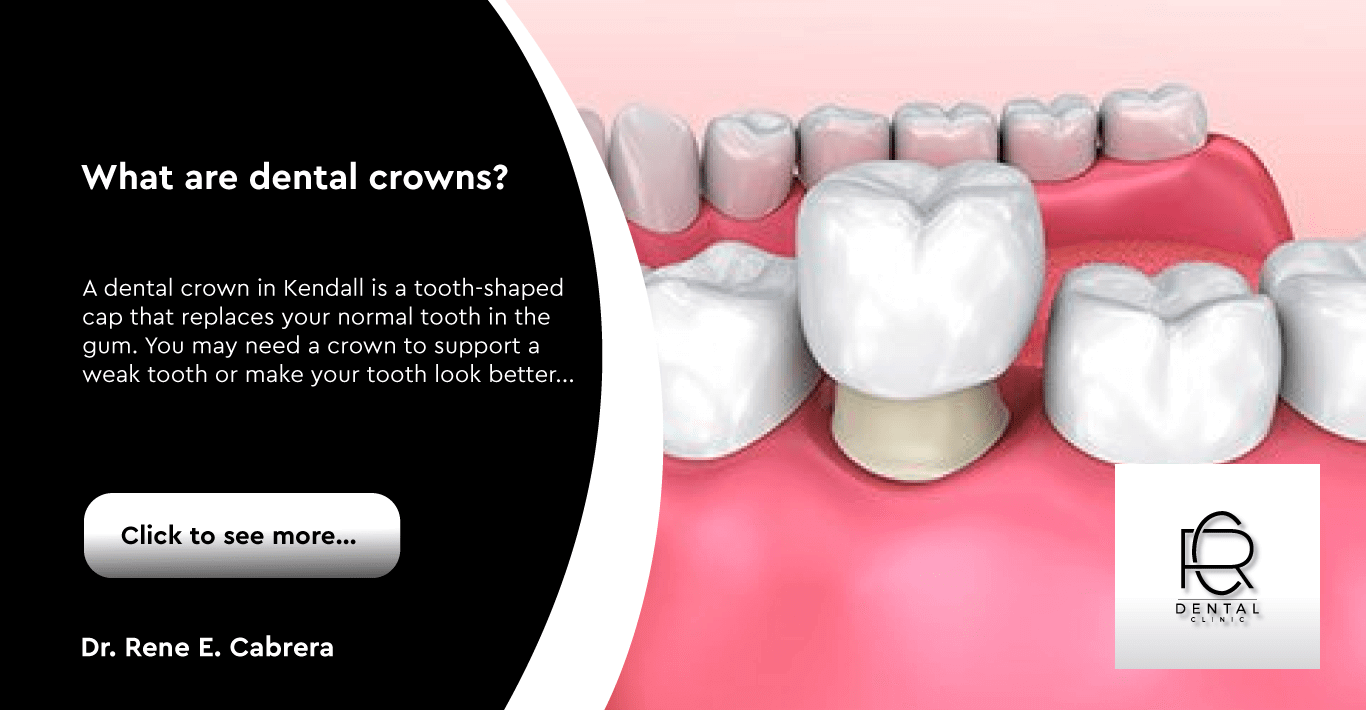 Dental Crowns in Kendall Dentist in Kendall