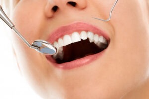limpieza dental profunda, Deep Cleaning Your Teeth